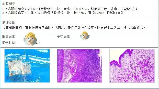 72岁老人眼疾背后惊现“寄生虫”，眼科医生揭开真相！