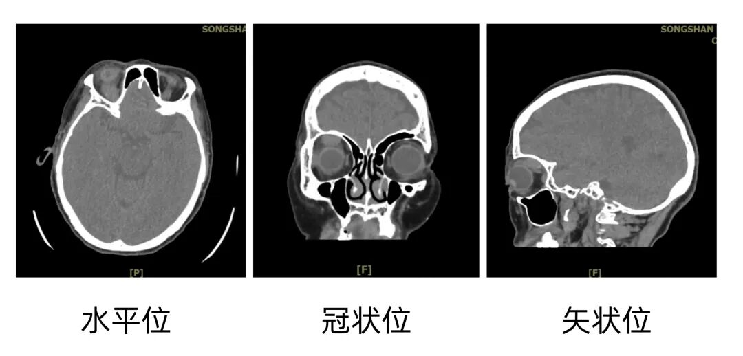 72岁老人眼疾背后惊现“寄生虫”，眼科医生揭开真相！