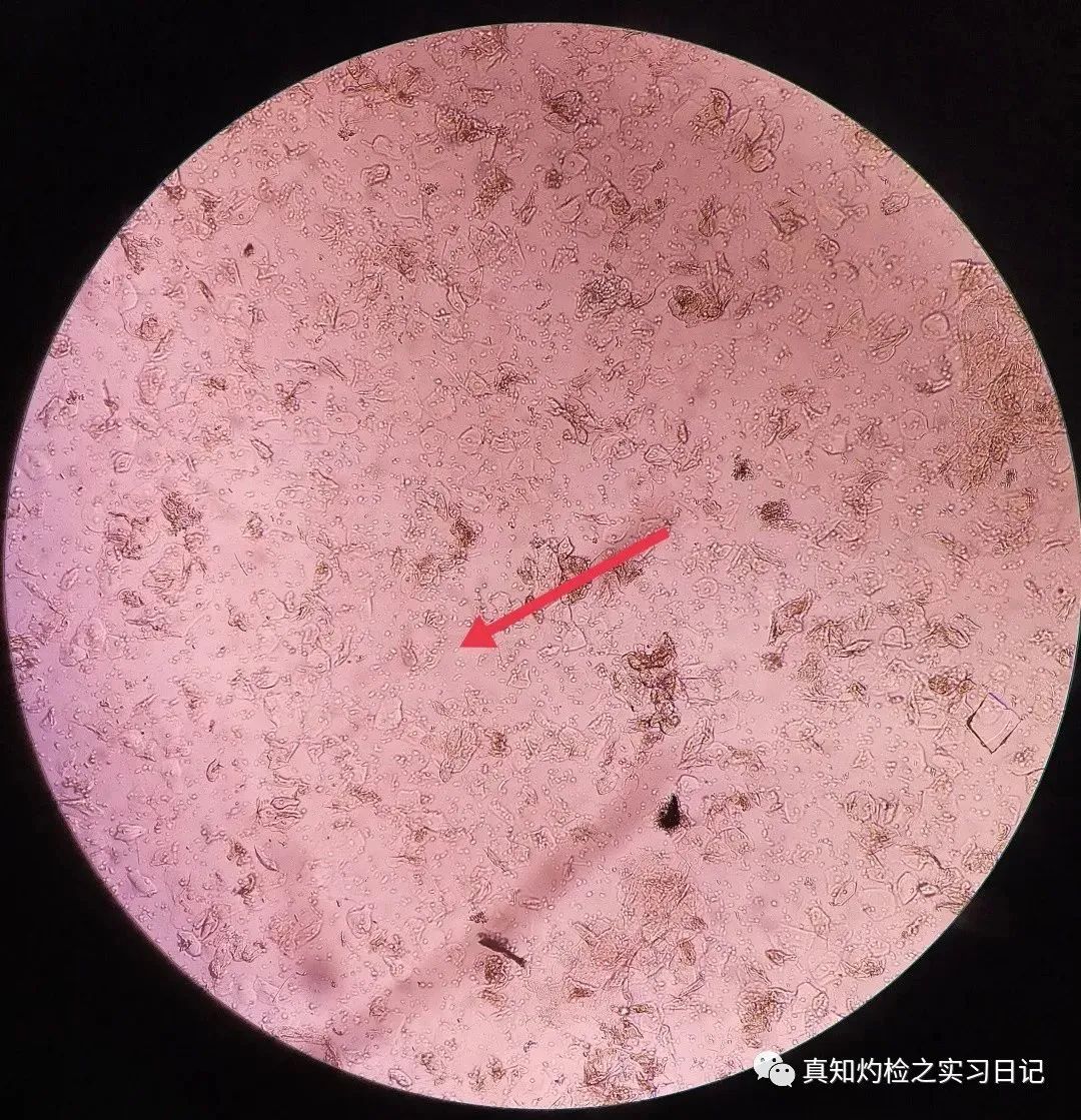 ▲杆菌及鳞状上皮细胞（低倍视野）形态特点：大量鳞状上皮细胞及大量的