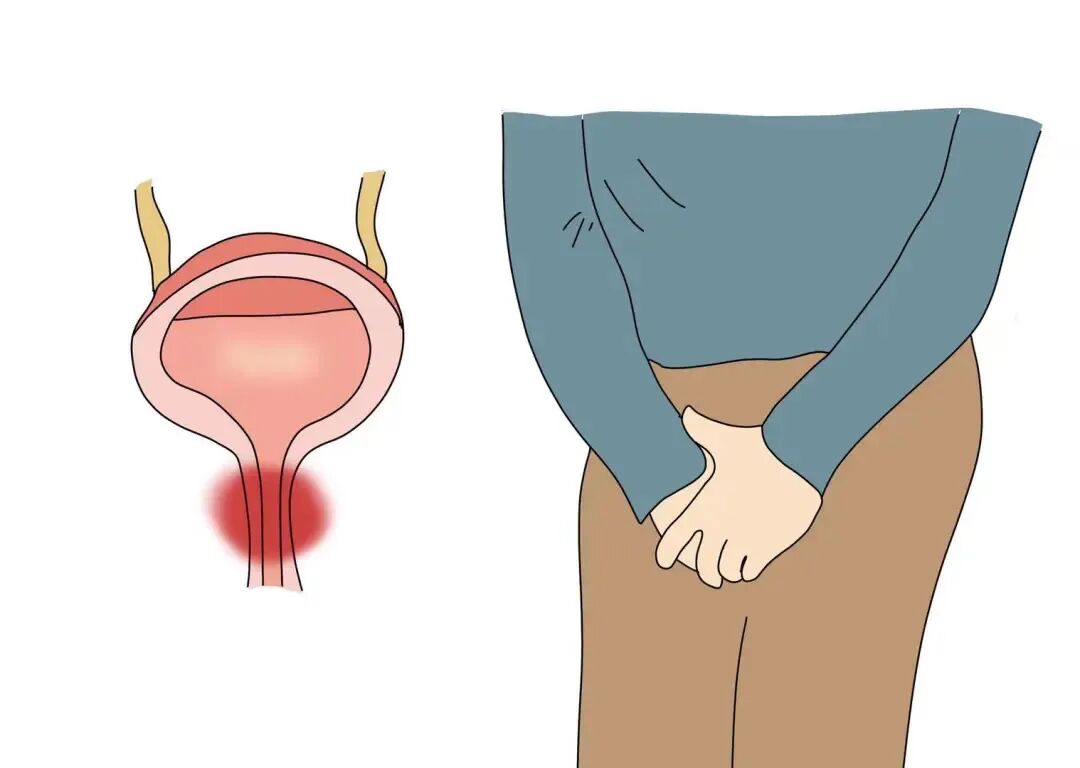 留置引流导管是什么浅谈留置导尿管_https://www.jmylbn.com_新闻资讯_第10张