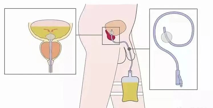 留置引流导管是什么浅谈留置导尿管_https://www.jmylbn.com_新闻资讯_第2张