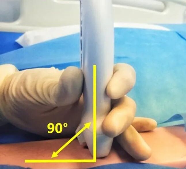 为什么20ml针筒的针在边上【静疗圈】超声引导下穿刺看不到针尖怎么办？_https://www.jmylbn.com_新闻资讯_第4张
