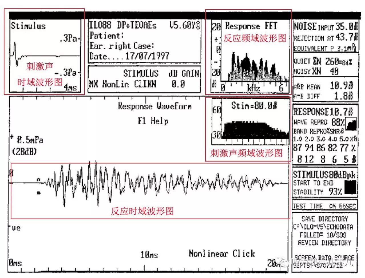 耳声发射图怎么看客观测听 ｜ 耳声发射_https://www.jmylbn.com_新闻资讯_第7张