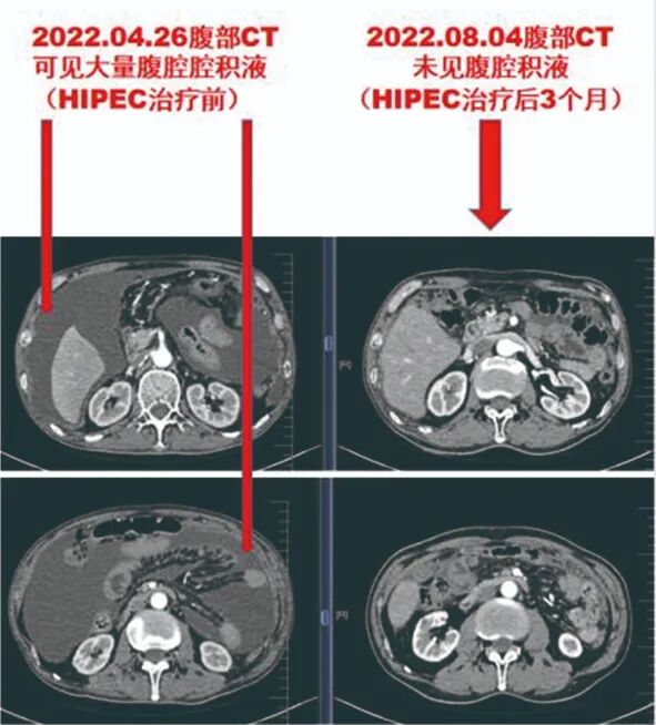 怎么用医疗灌注【省医专家说】用药物给腹腔“洗个澡”治疗恶性肿瘤腹膜（腔）转移_https://www.jmylbn.com_新闻资讯_第5张