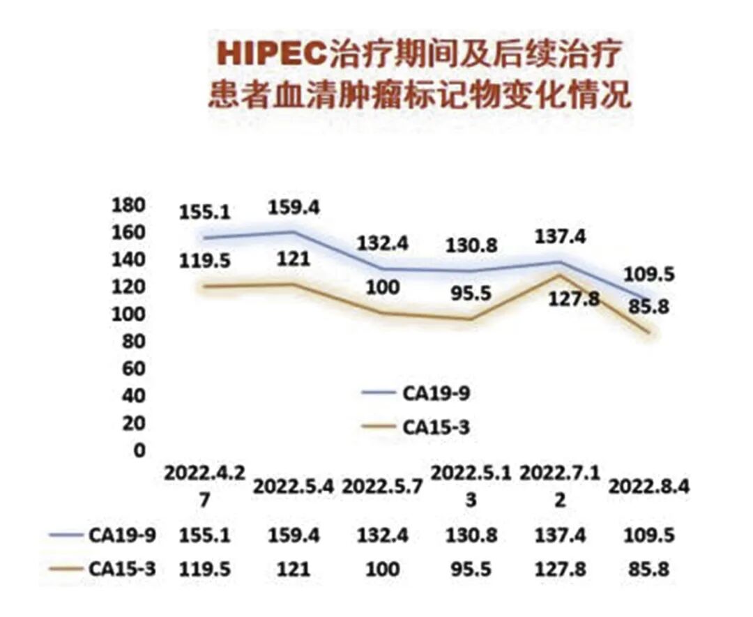怎么用医疗灌注【省医专家说】用药物给腹腔“洗个澡”治疗恶性肿瘤腹膜（腔）转移_https://www.jmylbn.com_新闻资讯_第6张