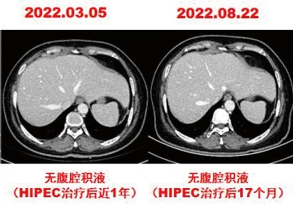 怎么用医疗灌注【省医专家说】用药物给腹腔“洗个澡”治疗恶性肿瘤腹膜（腔）转移_https://www.jmylbn.com_新闻资讯_第8张