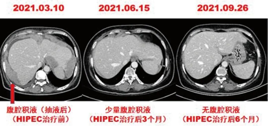 怎么用医疗灌注【省医专家说】用药物给腹腔“洗个澡”治疗恶性肿瘤腹膜（腔）转移_https://www.jmylbn.com_新闻资讯_第7张