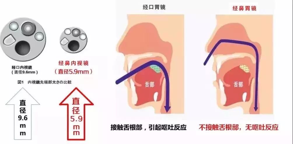 活检钳怎么消毒平常做的胃肠镜检查是如何消毒的？_https://www.jmylbn.com_新闻资讯_第9张