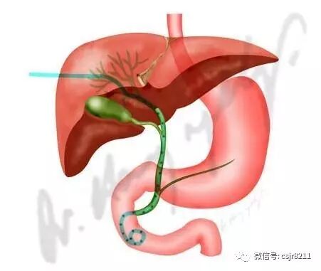 ptcd是什么器材经皮肝穿胆道引流术（PTCD）操作探讨（1）-上海聚慕医疗器械有限公司
