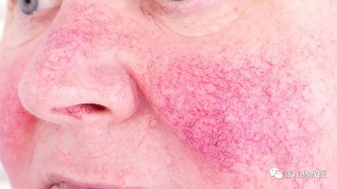 玫瑰痤疮,是一种主要发生于面部中央的红斑和毛细血管扩张的慢性炎症