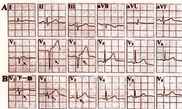 病理性Q波≠心肌梗死，