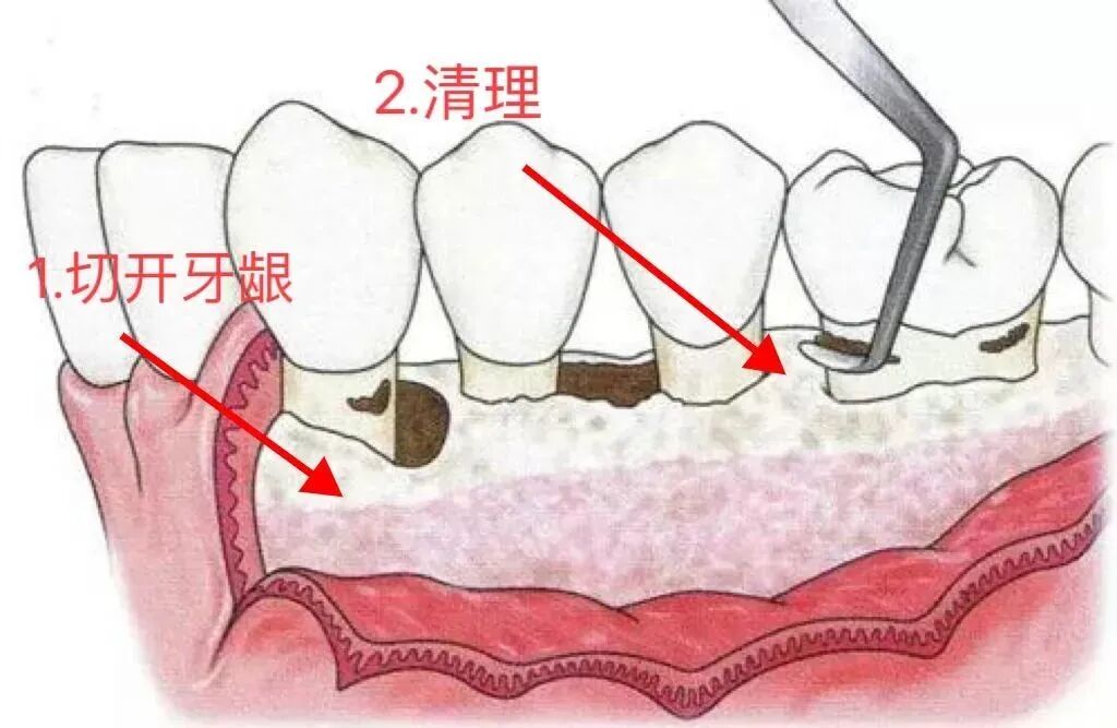 电刀怎么洗我以为只要洗个牙，医生你怎么还拿起了手术刀？_https://www.jmylbn.com_新闻资讯_第6张