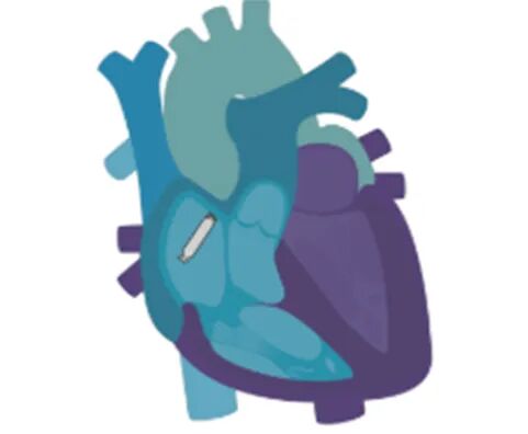 心脏是怎么固定的“心”希望，“新”动力 内蒙古自治区人民医院率先启用单心房主动固定无导线起搏器，引领心脏起搏技术新纪元_https://www.jmylbn.com_新闻资讯_第8张