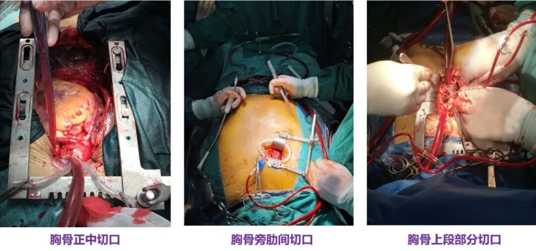 为什么叫哈巴狗钳2023学术荟萃｜王云：右侧肋间小切口体外循环心脏手术_https://www.jmylbn.com_新闻资讯_第4张