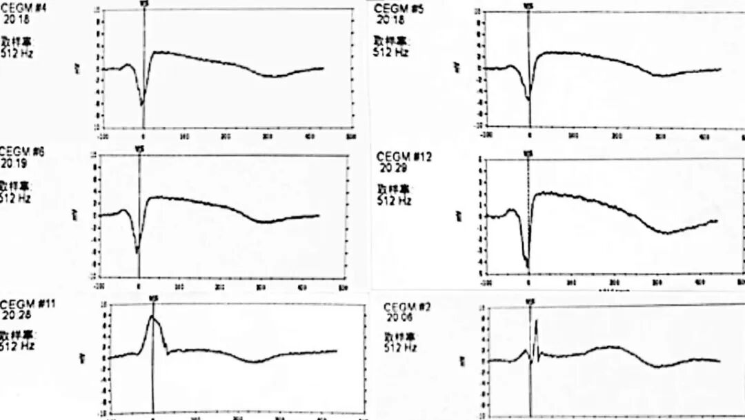 心脏是怎么固定的“螺旋固定，无线心动”——新型主动螺旋固定式无导线心脏起搏器植入术案例分享_https://www.jmylbn.com_新闻资讯_第25张