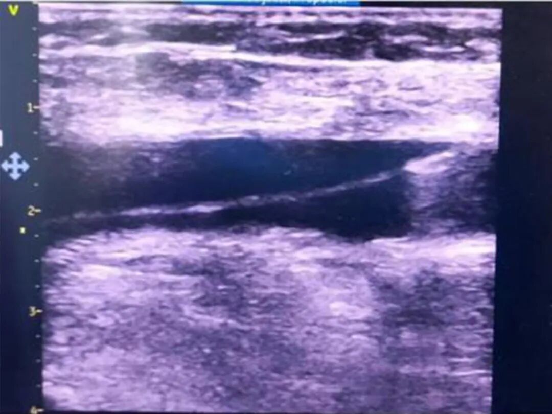 心脏是怎么固定的山西省心血管病医院心内4病区在超声指导下穿刺成功植入 主动螺旋固定式无导线心脏起搏器_https://www.jmylbn.com_新闻资讯_第9张