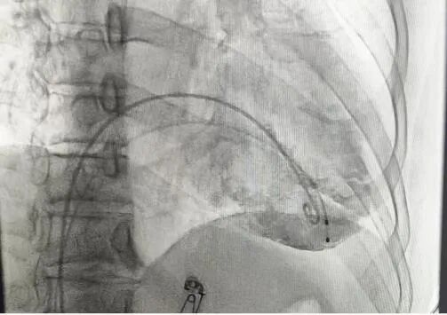 心脏是怎么固定的山西省心血管病医院心内4病区在超声指导下穿刺成功植入 主动螺旋固定式无导线心脏起搏器_https://www.jmylbn.com_新闻资讯_第11张