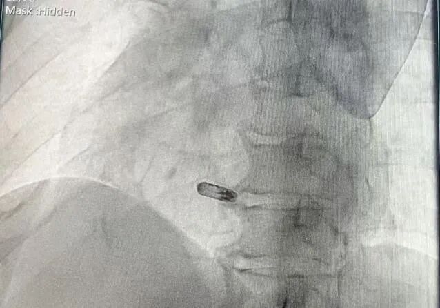 心脏是怎么固定的山西省心血管病医院心内4病区在超声指导下穿刺成功植入 主动螺旋固定式无导线心脏起搏器_https://www.jmylbn.com_新闻资讯_第25张