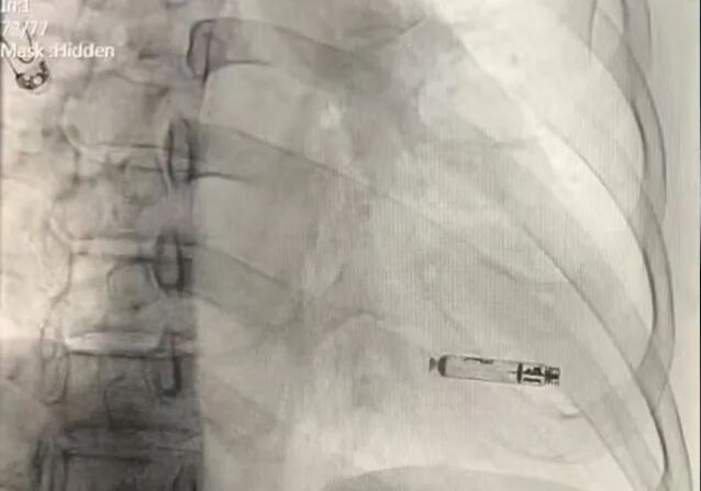 心脏是怎么固定的山西省心血管病医院心内4病区在超声指导下穿刺成功植入 主动螺旋固定式无导线心脏起搏器_https://www.jmylbn.com_新闻资讯_第24张