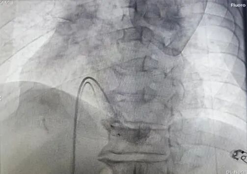 心脏是怎么固定的山西省心血管病医院心内4病区在超声指导下穿刺成功植入 主动螺旋固定式无导线心脏起搏器_https://www.jmylbn.com_新闻资讯_第12张
