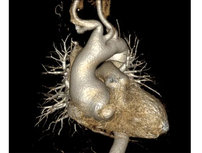 为什么叫哈巴狗钳2023学术荟萃｜王云：右侧肋间小切口体外循环心脏手术_https://www.jmylbn.com_新闻资讯_第12张