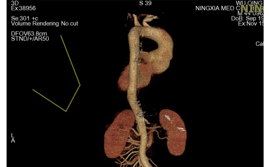 为什么叫哈巴狗钳2023学术荟萃｜王云：右侧肋间小切口体外循环心脏手术_https://www.jmylbn.com_新闻资讯_第10张