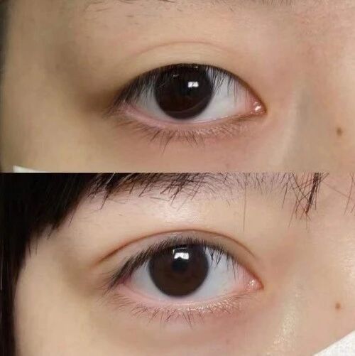 效果反馈不错的天津双眼皮医生刘光晶、刘容嘉、刘淑英、熊斌等