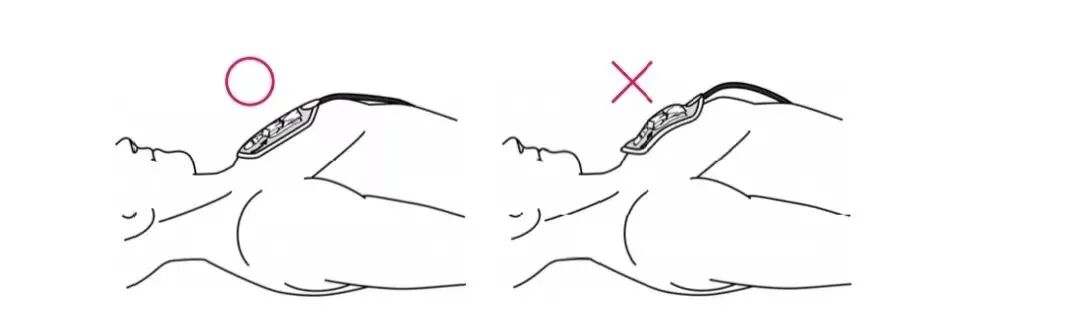 自动体外除颤器是什么自动体外除颤器AED_https://www.jmylbn.com_新闻资讯_第11张