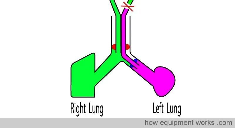 气管插管的管是什么气管插管的作用是什么？_https://www.jmylbn.com_新闻资讯_第33张