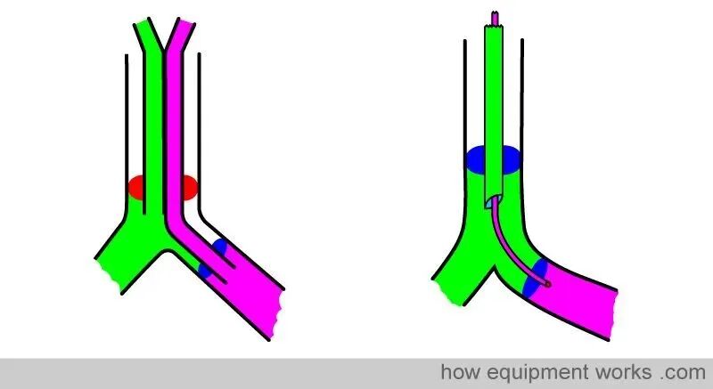 气管插管的管是什么气管插管的作用是什么？_https://www.jmylbn.com_新闻资讯_第41张