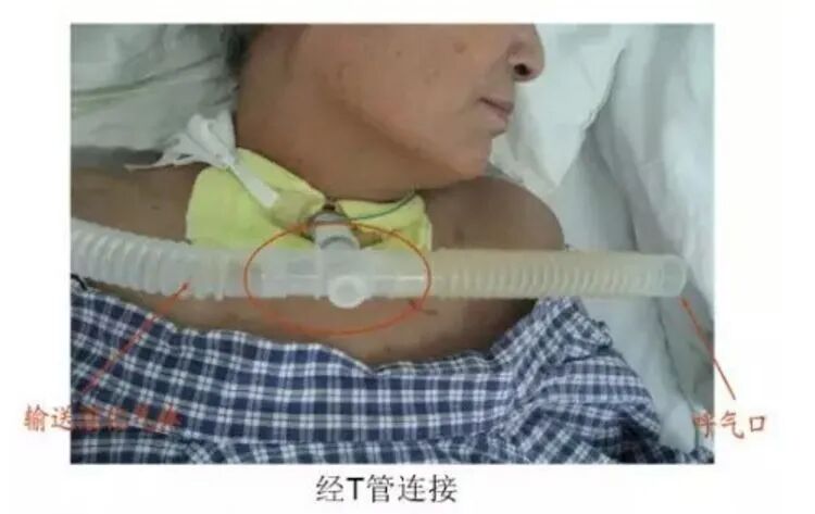 氧浓度怎么调节文丘里面罩，是这样的！_https://www.jmylbn.com_新闻资讯_第16张