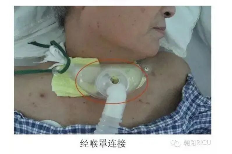 氧浓度怎么调节文丘里面罩，是这样的！_https://www.jmylbn.com_新闻资讯_第17张