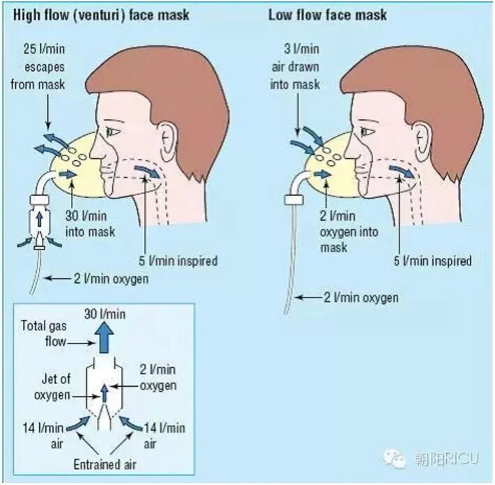 氧浓度怎么调节文丘里面罩，是这样的！_https://www.jmylbn.com_新闻资讯_第12张