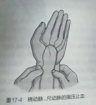 上肢夹板怎么用各种常见创伤急救措施，一文总结！_https://www.jmylbn.com_新闻资讯_第4张