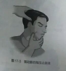 上肢夹板怎么用各种常见创伤急救措施，一文总结！_https://www.jmylbn.com_新闻资讯_第3张