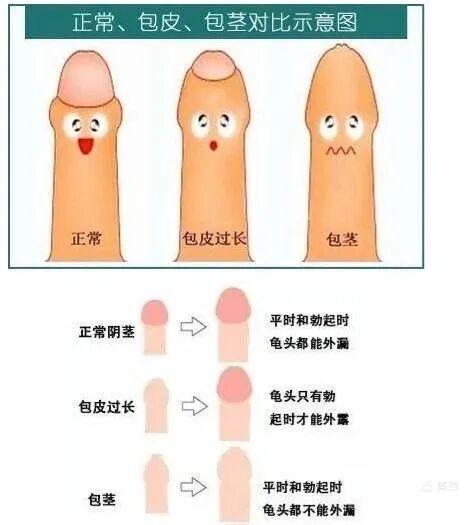 包皮吻合器是什么更快、更无痛、更微创的包皮环切术----吻合器包皮环切术甘霖有专家哦_https://www.jmylbn.com_新闻资讯_第3张