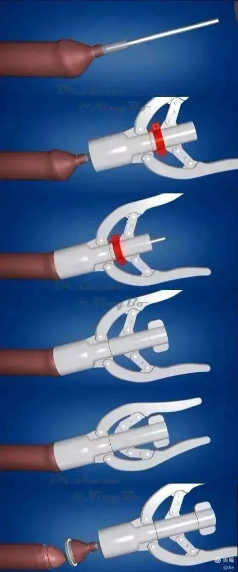 包皮吻合器是什么更快、更无痛、更微创的包皮环切术----吻合器包皮环切术甘霖有专家哦_https://www.jmylbn.com_新闻资讯_第6张