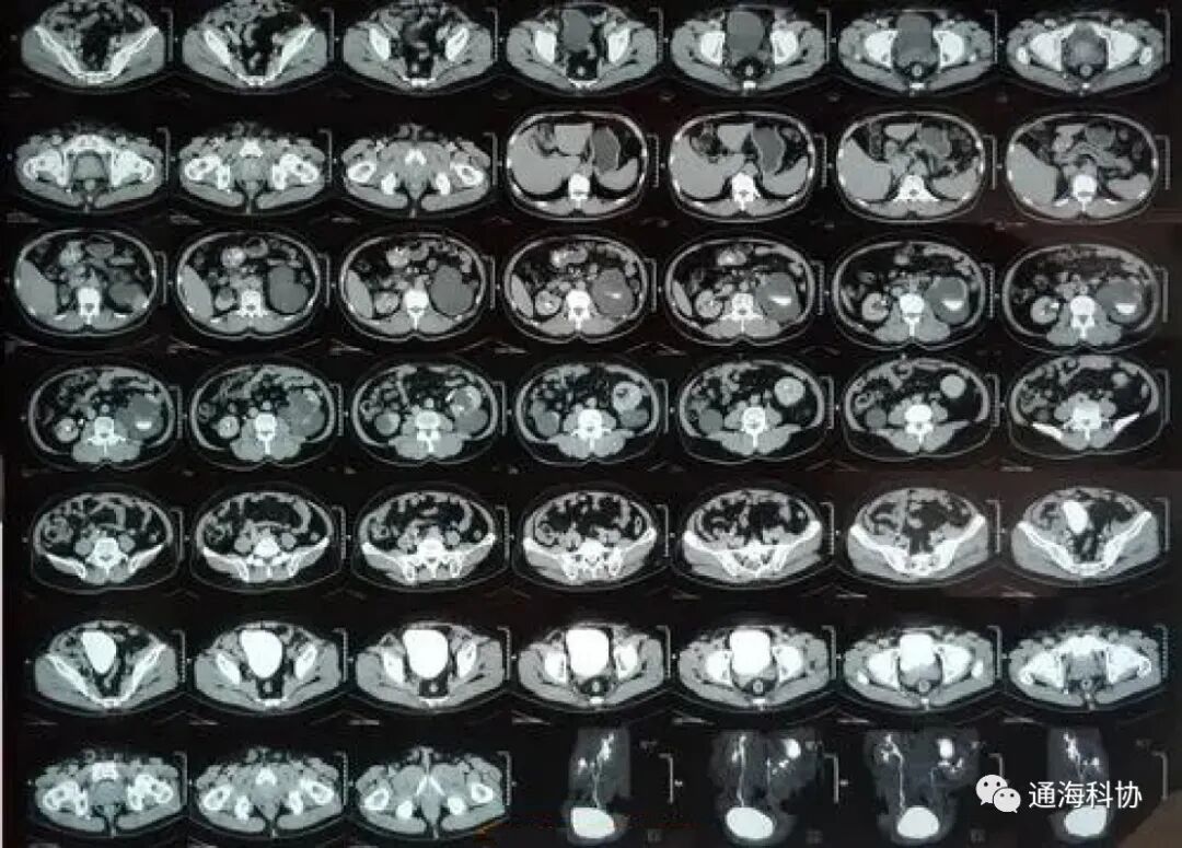 b超md是什么意思ct、核磁、b超有什么区别，工作原理是什么？看完涨知识_https://www.jmylbn.com_新闻资讯_第3张