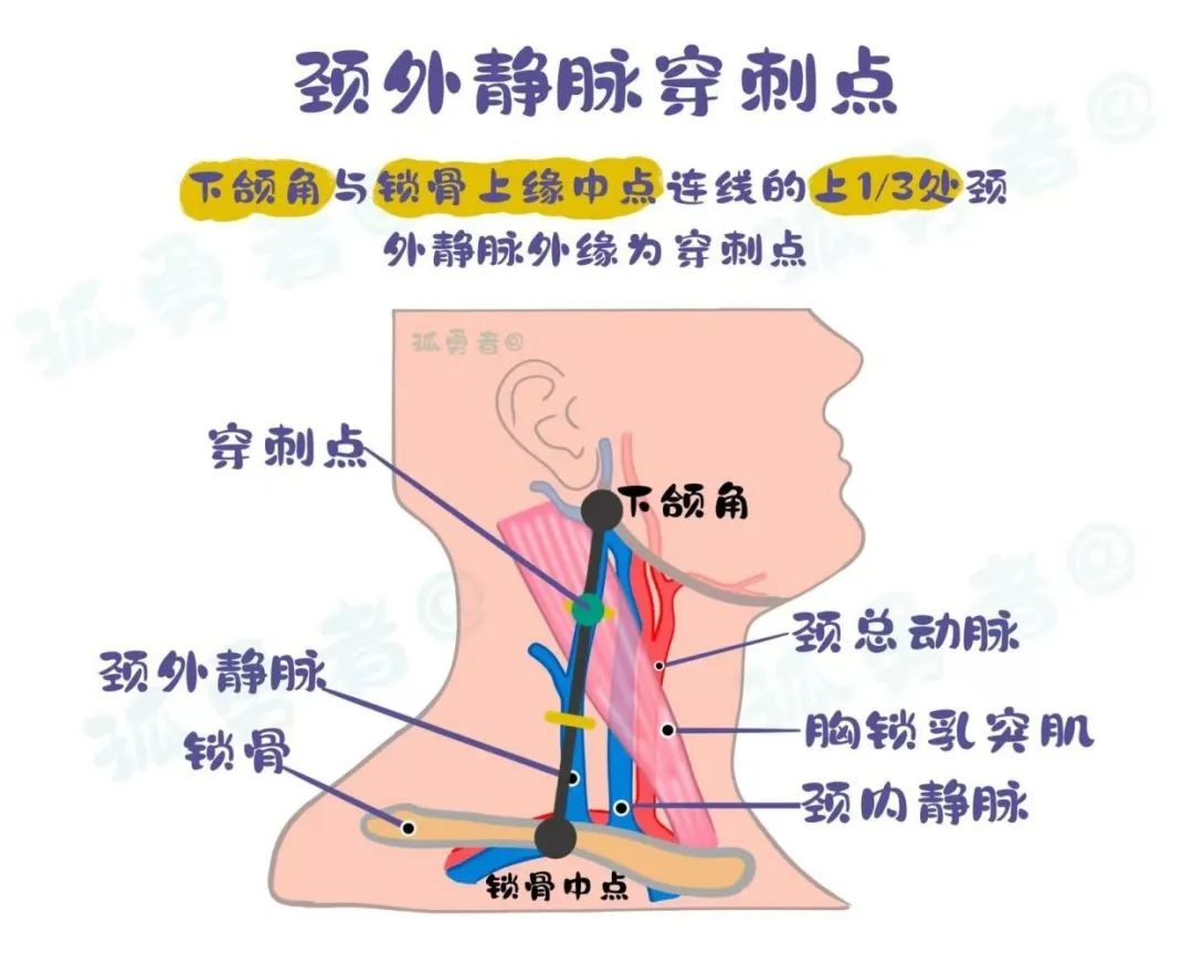 颈静脉在哪个位置图片