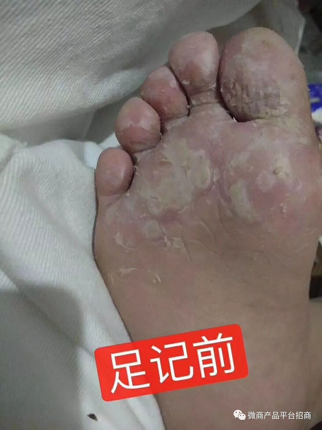 脚气怎么治能除根 请问用什么药治疗效果最好 微商产品平台招商 微信公众号文章阅读 Wemp