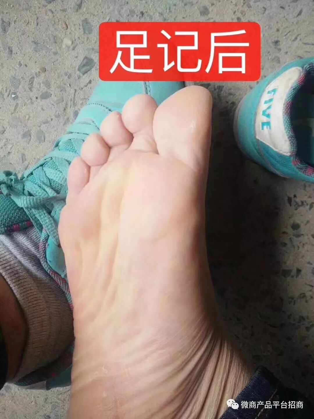 脚气怎么治能除根 请问用什么药治疗效果最好 微商产品平台招商 微信公众号文章阅读 Wemp