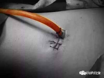 三腔引流管有哪些临床常见引流管_https://www.jmylbn.com_新闻资讯_第6张