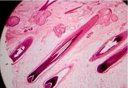 是什么导致毛囊闭合？