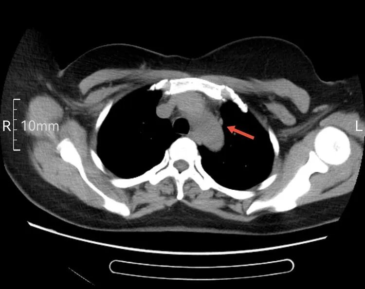 为什么建立双输液通道输液港 偶遇“双上腔静脉”_https://www.jmylbn.com_新闻资讯_第3张