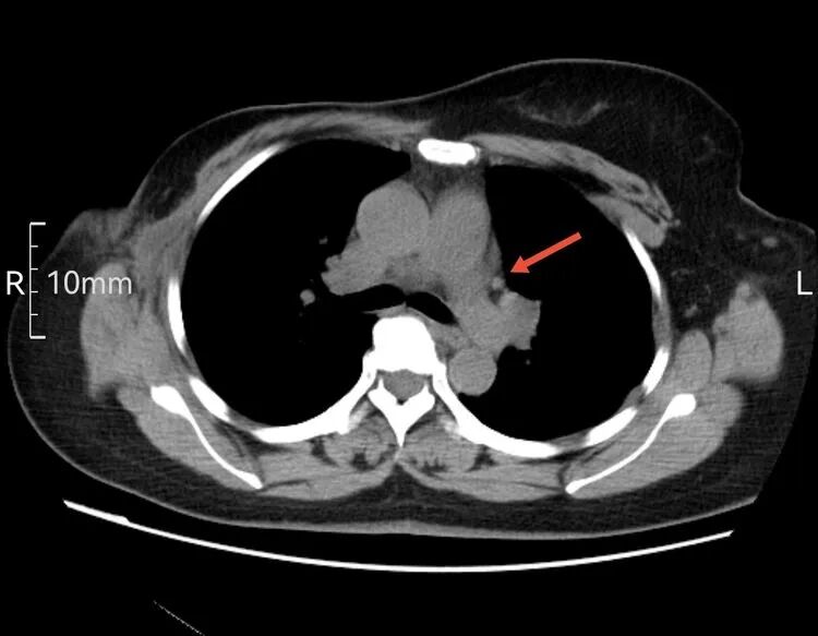 为什么建立双输液通道输液港 偶遇“双上腔静脉”_https://www.jmylbn.com_新闻资讯_第5张