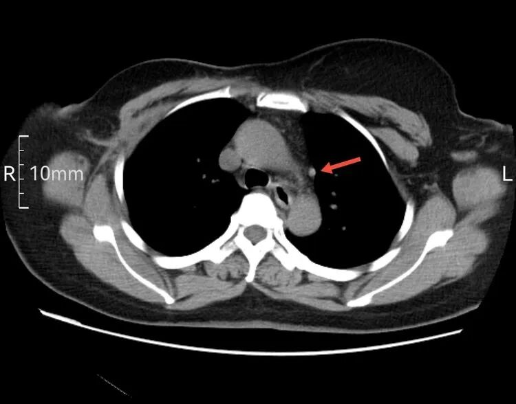 为什么建立双输液通道输液港 偶遇“双上腔静脉”_https://www.jmylbn.com_新闻资讯_第4张