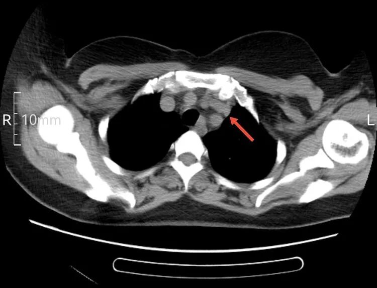 为什么建立双输液通道输液港 偶遇“双上腔静脉”_https://www.jmylbn.com_新闻资讯_第2张