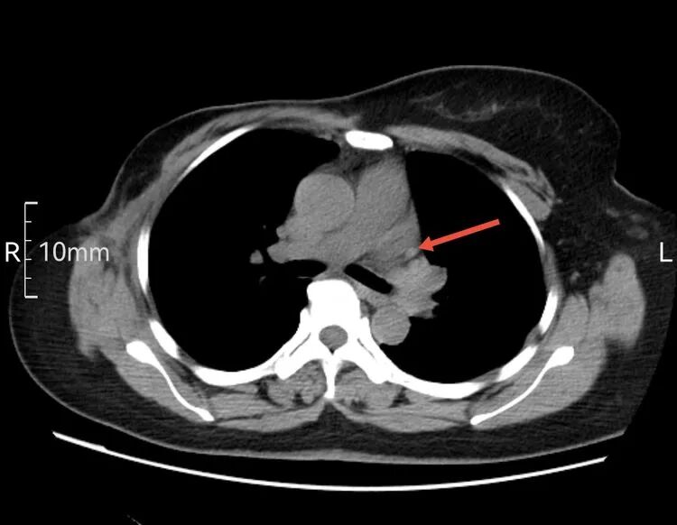 为什么建立双输液通道输液港 偶遇“双上腔静脉”_https://www.jmylbn.com_新闻资讯_第6张