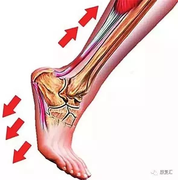 跖筋膜炎跖腱膜与足纵弓及跖趾关节关系密切,跖趾关节背伸时跖腱膜最
