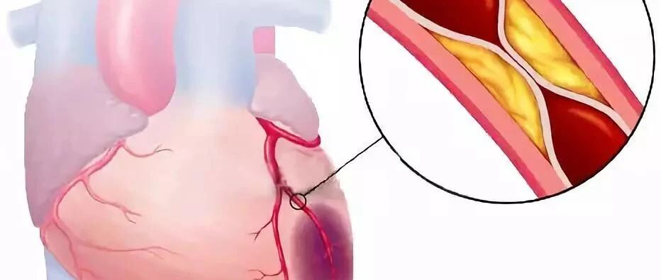 99%的血栓无征兆，记住一个字，让你一生无栓！